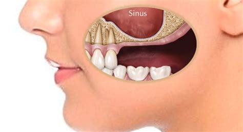 Bone Grafting And Sinus Lifts Brushwell Dental Implants