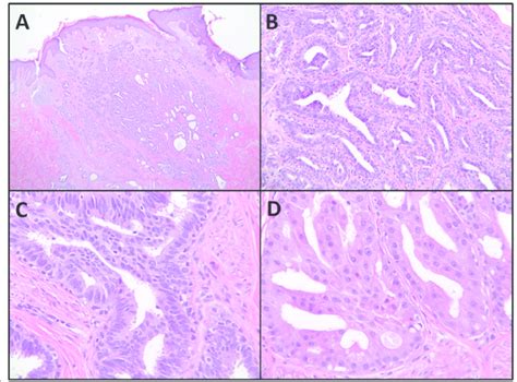 Histologic Examination Of The Excised Right Nipple Tissue A Low Power