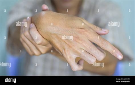 Ulnar Claw Hand Of Asian Young Man Also Known As Spinster Claw