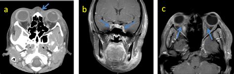 Figure 1 From A Case Report Of Cavernous Sinus Thrombosis After Trauma Semantic Scholar