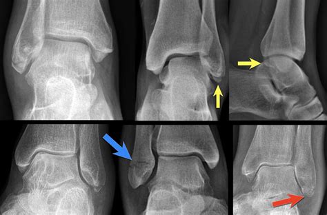 The Radiology Assistant : Ankle fracture - Weber and Lauge-Hansen ...