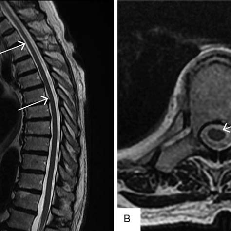 T Weighted Mri Images Demonstrating An Epidural Hematoma Sagittal The