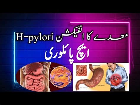 H Pylori Infection Causes Transmission And Treatment Explained