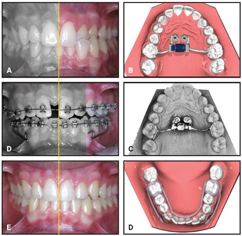 Digital Ortho Lab Custom Boneborne Marpe Design