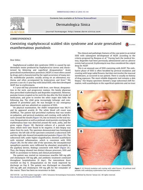 Pdf Coexisting Staphylococcal Scalded Skin Syndrome And Acute