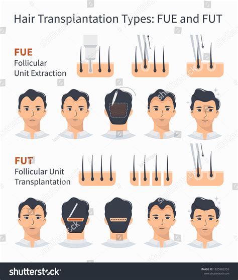 Types Stages Hair Transplantation Fue Fut Stock Vector Royalty Free