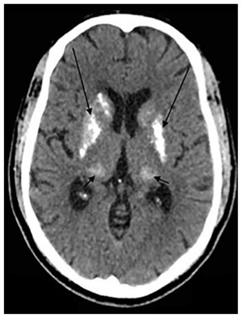 Cmv Periventricular Calcification