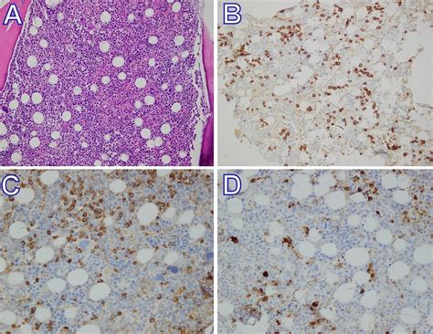 Bone Marrow Biopsy Shows Normocellular Marrow With Appropriate