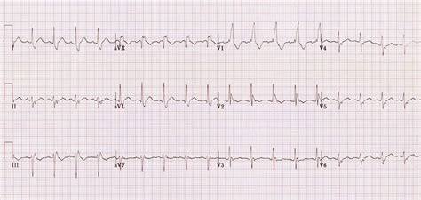 Bifascicular Block • Litfl • Ecg Library Diagnosis