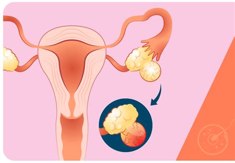 Endometriomas exames e diagnóstico Art Fértil