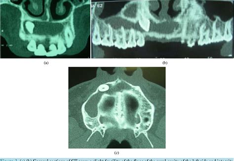 Figure From Odontogenic Keratocyst Tumor A Case Report And