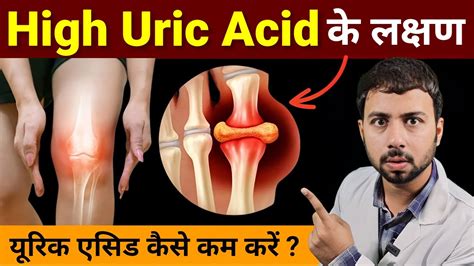 यूरिक एसिड कैसे काम करें How To Control Uric Acid Naturally High