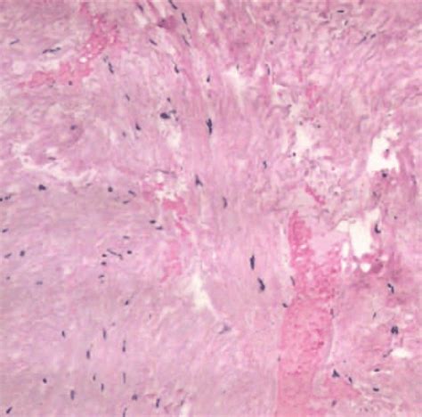 Histological findings showed erythrocytes and hemosiderin deposition ...