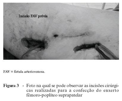 SciELO Brasil Tratamento da síndrome do roubo devido a fístula