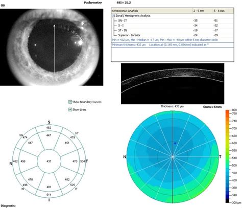 Ocular Imaging Fast Track Assessment Centre Corneal Abnormalities