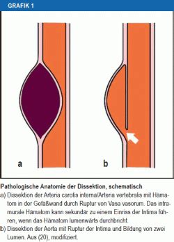 Klinik Der Dissektionen Hirnversorgender Halsarterien