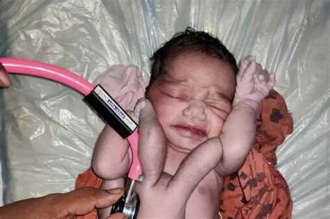 Baby Born With Four Arms And Four Legs In India Is Hailed A Miracle