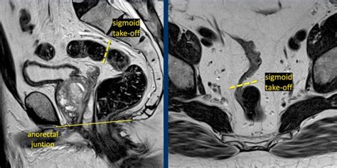 Mri Ung Thư Trực Tràng Mri Of Rectal Cancer Radiology ChẨn ĐoÁn HÌnh Ảnh