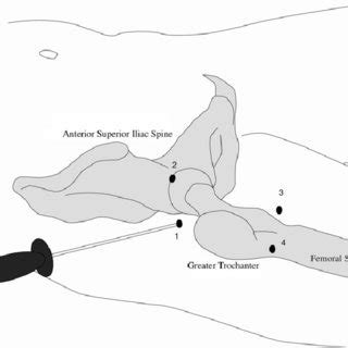 Routine Portals For Hip Arthroscopy Lateral Cm Proximal And