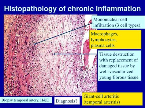 Ppt First Foundations In Pathology Part 2 Acute And Chronic