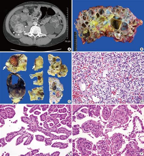 A Abdominal Computed Tomography Shows A Heterogeneous Well Enhanced Download Scientific