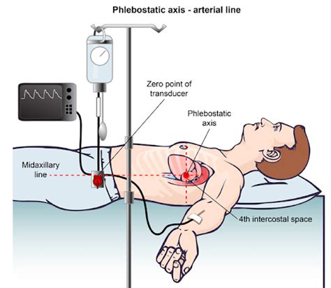 Arterial Pressure Abp A Line Monitoring Zeroing Wave 이해하기 네이버 블로그