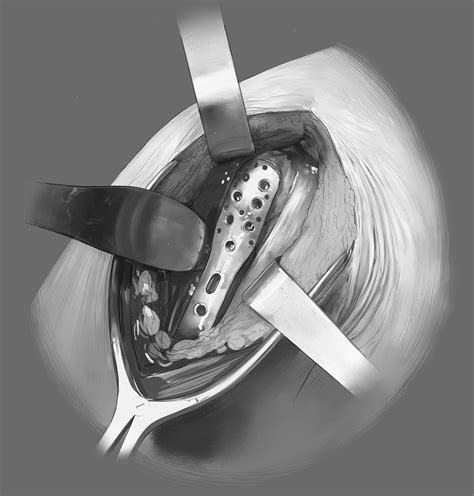 Surgical Illustration Proximal Humeral Fracture Repair On Behance