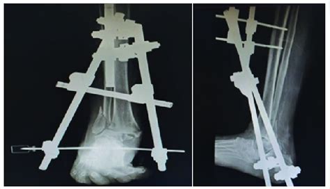 X-ray of right ankle joint (anteroposterior/lateral view) with ankle ...