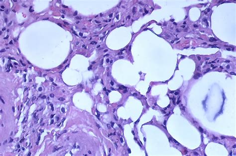 Pseudolipid Pneumoniaair Bubble Artifact Case 223 Flickr