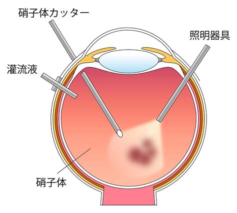 日帰り硝子体手術茨城県水戸市の小沢眼科内科病院