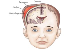 Cephalohematoma Causes Symptoms Treatment Complications