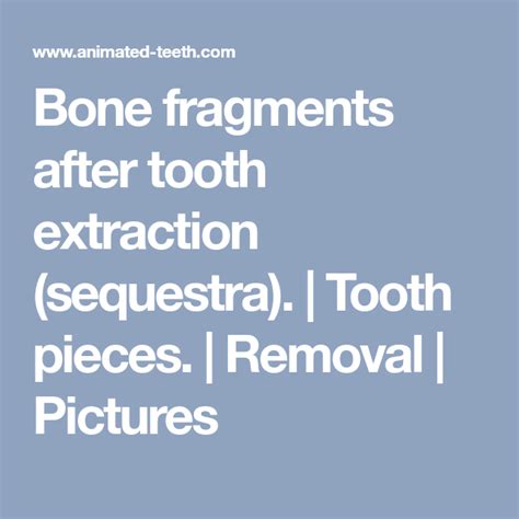 Bone Fragments After Tooth Extraction Sequestra Tooth Pieces