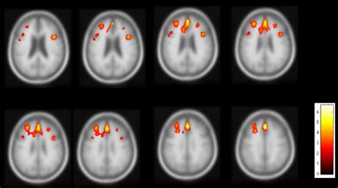 Results From A Concordance Analysis Of Both Gray Matter Atrophy And