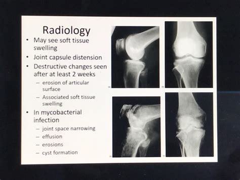 Bone And Joint Infections Flashcards Quizlet