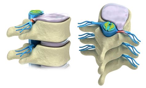 A Bulging Herniated Or Slipped Disc Can Repair Itself The Disc