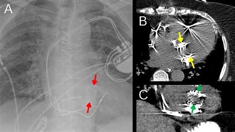 Transcatheter Mitral Valve Replacement Tmvr