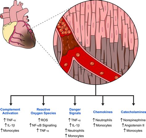 Myocardial Infarction