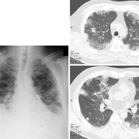 Pdf A Case Of Daptomycin Induced Eosinophilic Pneumonia And A Review