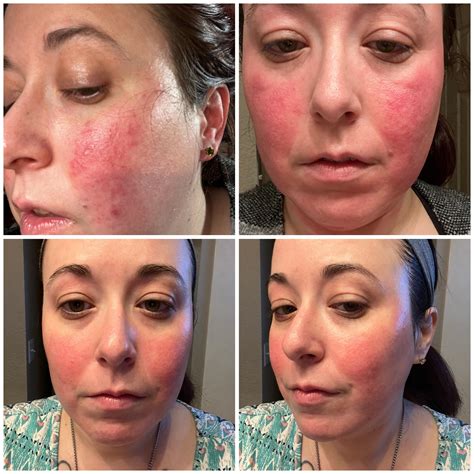 Rosacea Treatment Cream