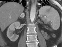 Recurrent Renal Cell Carcinoma With Vascular Metastases To Right