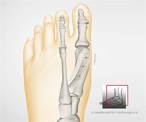 Hallux Valgus Wann Konservativ Wann Operativ Behandeln Off