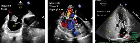 Percutaneous Debulking Of A Tricuspid Valve Papillary Fibroelastoma A