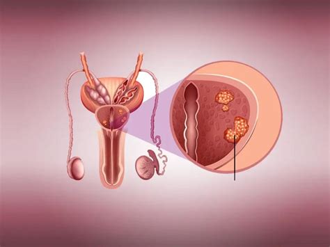 Prostat Nedir Ve Ne E Yarar Dr M Teba Sevil Sa L K