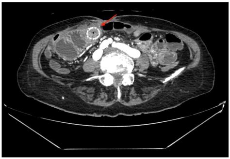 Intestinal Fistula