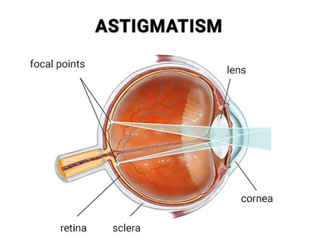 Astigmatism Treatments in NYC - Best Eye Doctors in New York