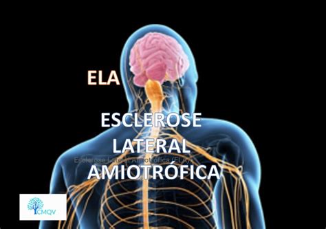 Esclerose Lateral Amiotr Fica Ela Consulte Vida