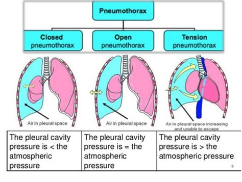 Pulmonary Patho Flashcards Quizlet