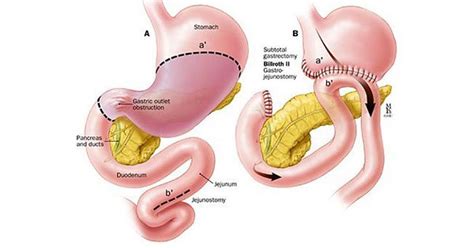 Gastric Outlet Obstruction