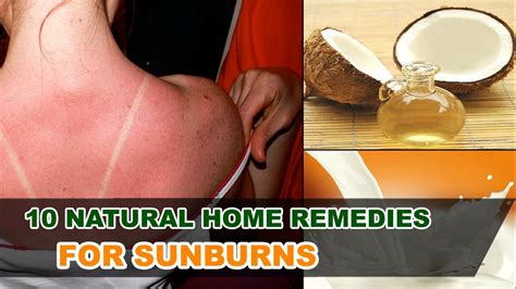 Top 10 Natural Home Remedies For Sunburn Relief For Sunburn Blisters Youtube