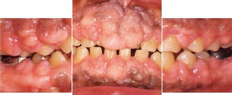 Intraoral View Of Gingival Overgrowth The Patient Had Drastically